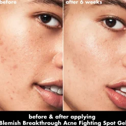 Blemish Breakthrough Acne Fighting Spot Gel