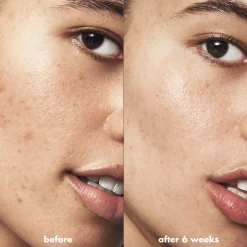 Blemish Breakthrough Blemish Control Basics Kit