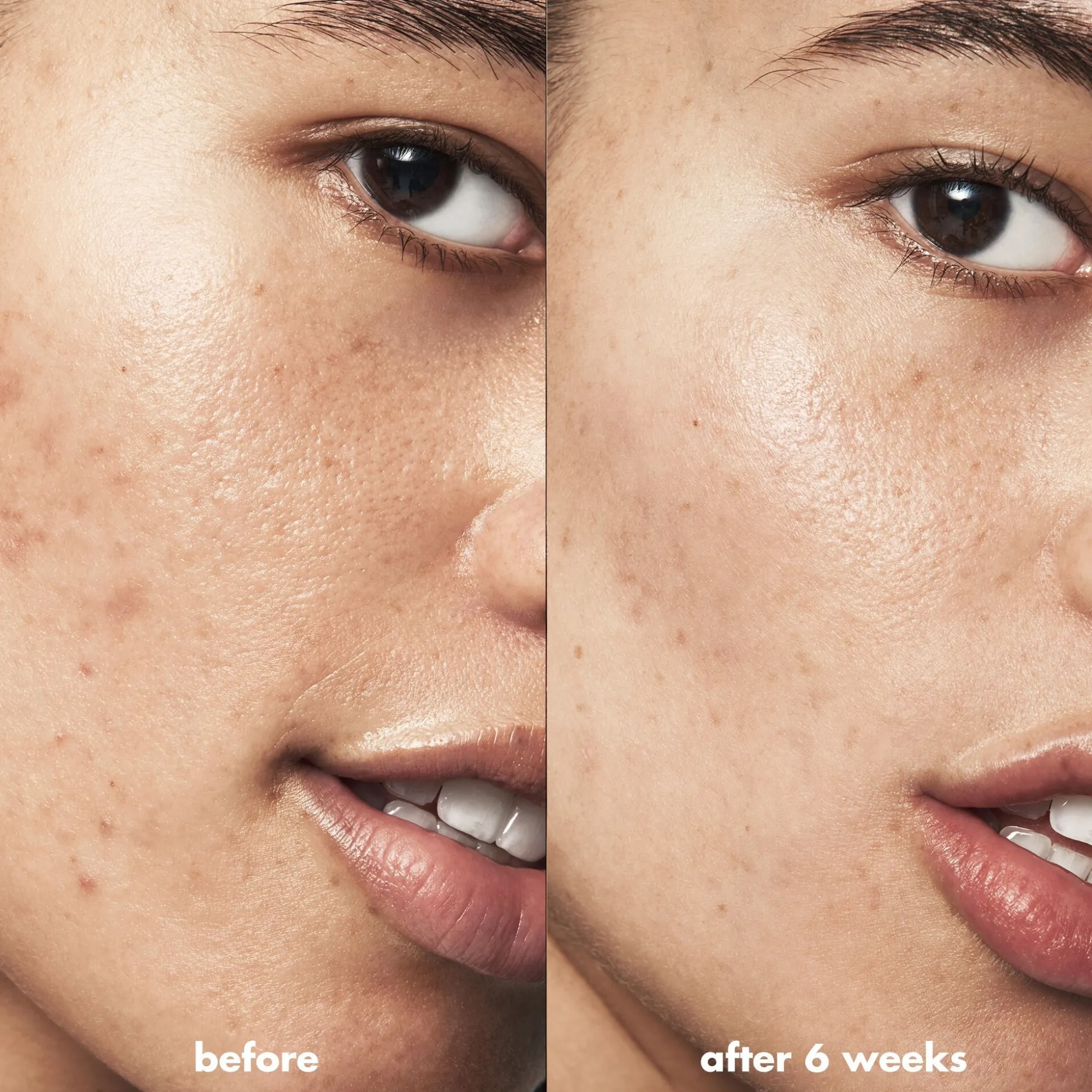 Blemish Breakthrough Blemish Control Basics Kit