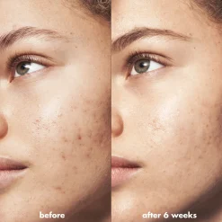 Blemish Breakthrough Blemish Control Basics Kit